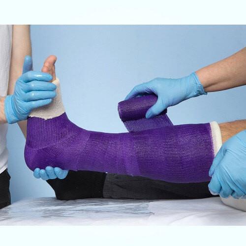 Benecast Select Casting Tape being applied for a Below Knee Conventional Cast.