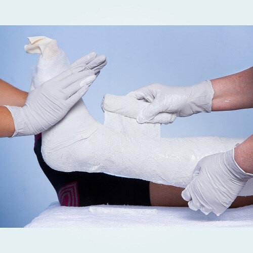 Benecast Gold Plaster of Paris being a applied for a below knee POP cast.
